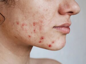 Leia mais sobre o artigo Como acabar com as acnes de forma natural